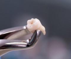 Tooth Extractions in Chicago