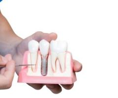Dental Implants in O'Fallon
