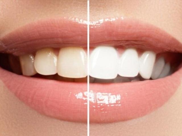 Teeth Whitening Treatment in Burbank